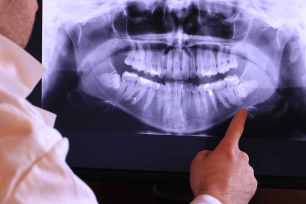 Best Emergency Wisdom Teeth Removal in Ocean Gate, NJ