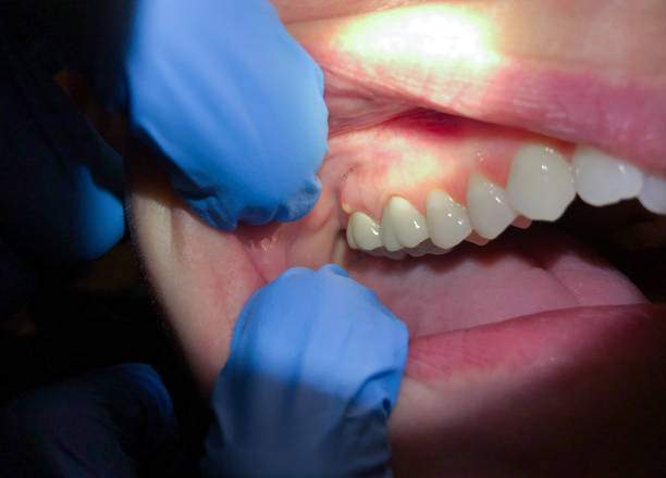 Best Emergency Denture Repair in Ocean Gate, NJ